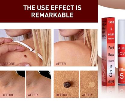 Tags & Moles Remover