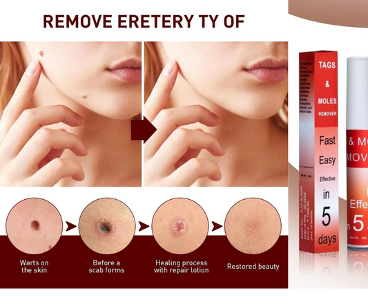 Tags & Moles Remover