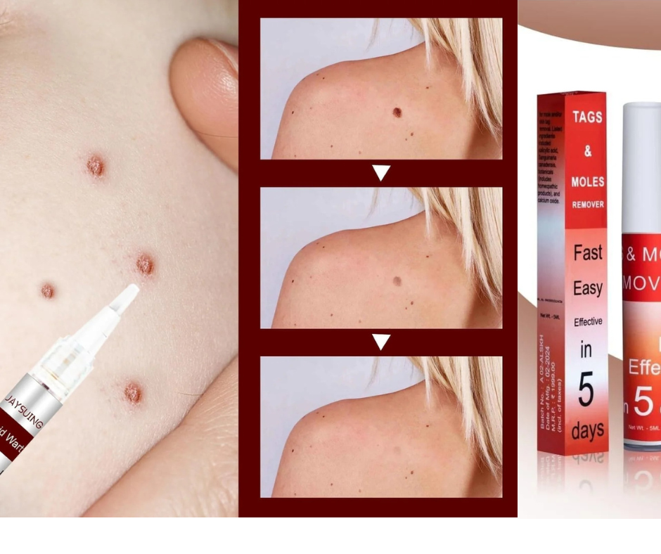 Tags & Moles Remover